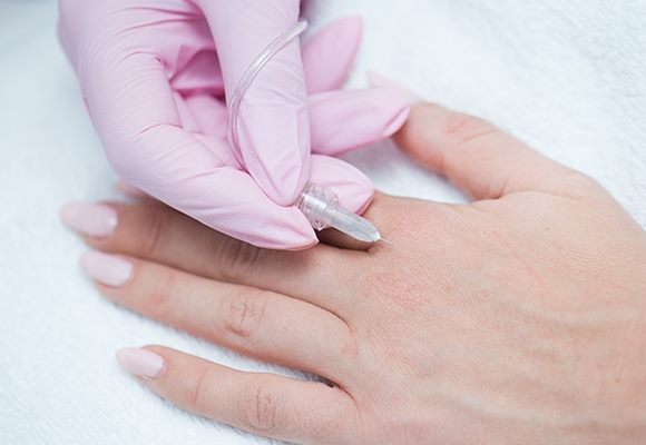 Zabieg karobksyterapii na dłoniach